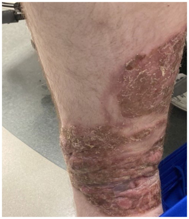 Tumor Stage Mycosis Fungoides with Lymph Node Involvement.
