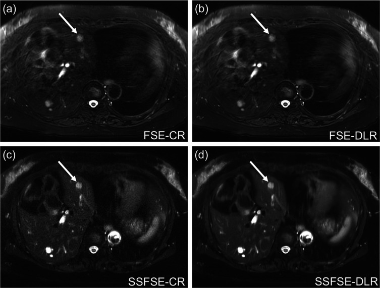 Effect of Deep Learning Reconstruction on Respiratory-triggered T2-weighted MR Imaging of the Liver: A Comparison between the Single-shot Fast Spin-echo and Fast Spin-echo Sequences.