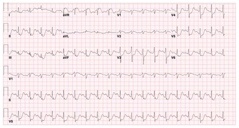 Kounis Syndrome as a Cause of Myocardial Infarction with Nonobstructive Coronary Arteries.