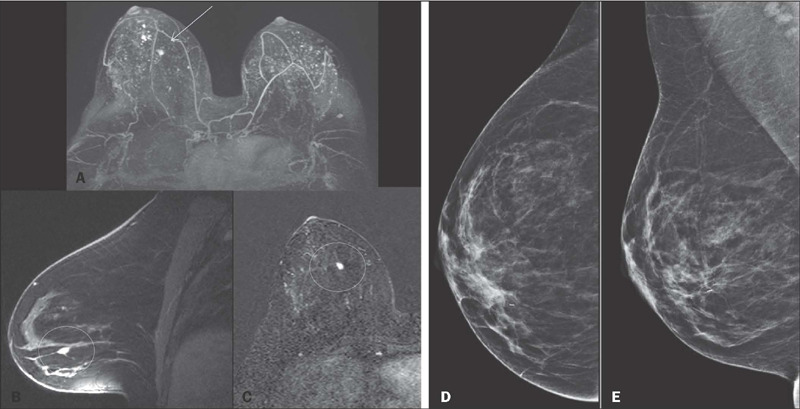 Analysis of the indications for and results of breast cancer screening by magnetic resonance imaging at a cancer center in Brazil.
