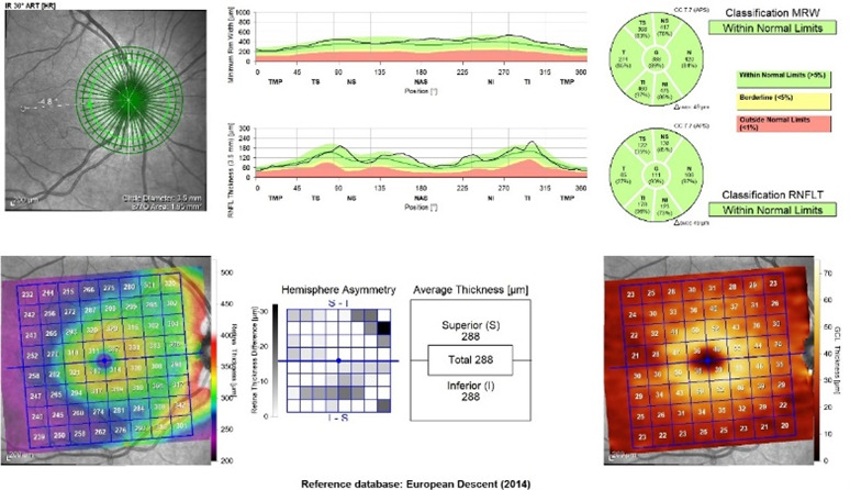 Comparative Analysis of Retinal Structural and Angiographic Parameters in Diabetic Patients, Alzheimer's Disease Patients, and Healthy Controls: An OCT-Based Study.