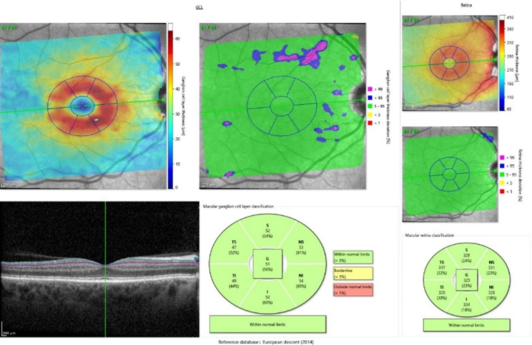 Comparative Analysis of Retinal Structural and Angiographic Parameters in Diabetic Patients, Alzheimer's Disease Patients, and Healthy Controls: An OCT-Based Study.
