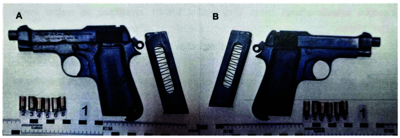 CIVILIAN GUNSHOT VICTIM WITH LOW-ENERGY BULLET INJURIES TO LOWER EXTREMITIES AND ATYPICAL LEFT DISTAL FEMUR FRACTURE: A CASE REPORT.