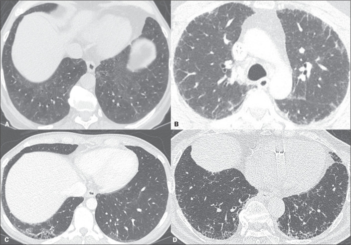 "Interstitial lung abnormalities": translation to and use in Portuguese.
