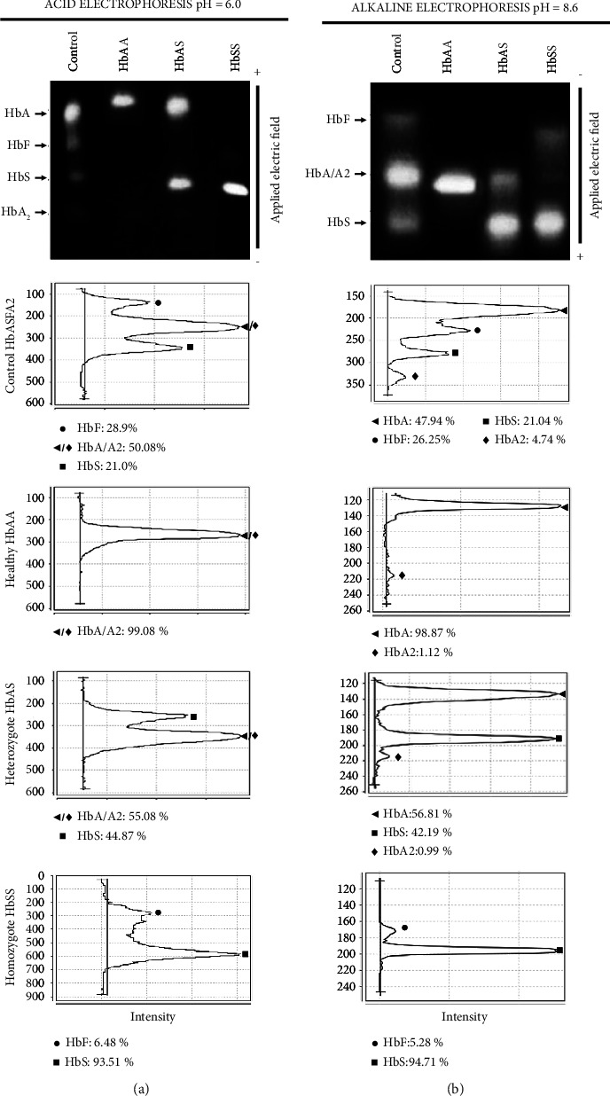 Detection of Asymptomatic Sickle Cell Hemoglobin Carriers and Fetal Hemoglobin Regulating Genetic Variants in African Descendants from Oaxaca, Mexico.