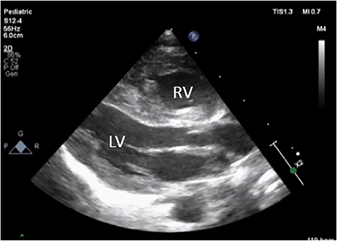 Persistent pulmonary hypertension of the newborn infant (PPHN) due to premature closure of the ductus arteriosus (DA).