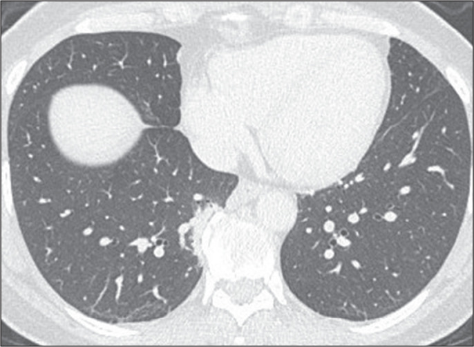 "Interstitial lung abnormalities": translation to and use in Portuguese.