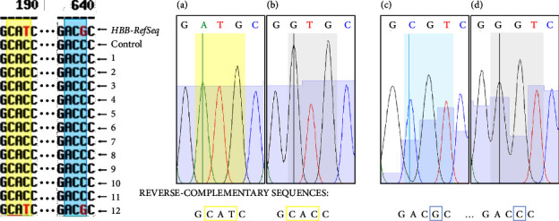 Detection of Asymptomatic Sickle Cell Hemoglobin Carriers and Fetal Hemoglobin Regulating Genetic Variants in African Descendants from Oaxaca, Mexico.
