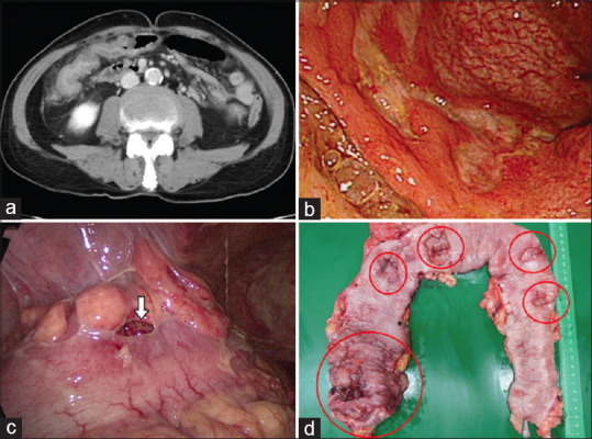 Primary colonic natural-killer T-cell lymphoma mimicking Crohn's disease.