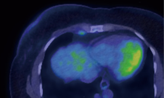 Internal mammary lymphadenopathy in breast cancer: a narrative review and update.