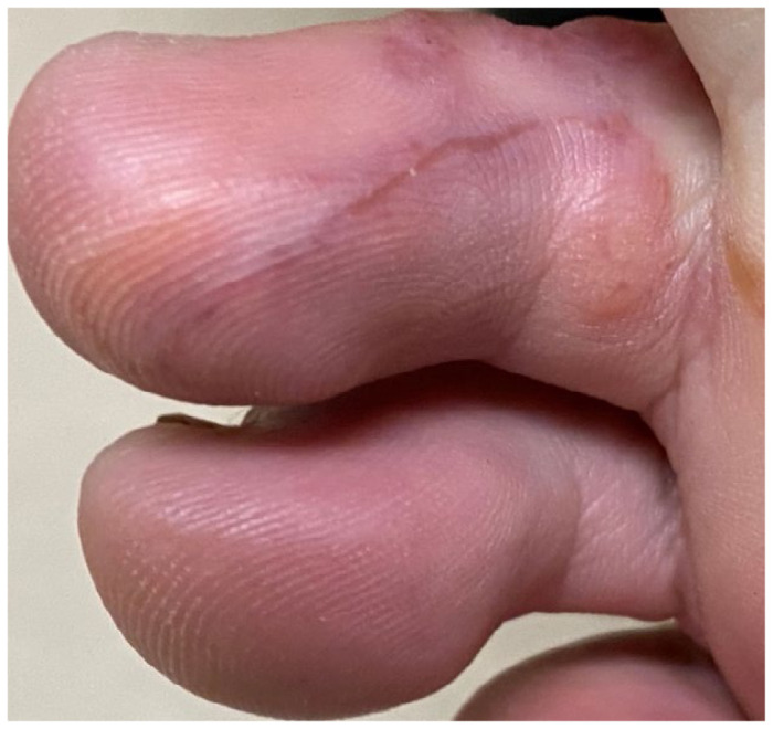Case Report of Serpiginous Rash on Foot in a Patient after Recent Travel to Brazil.