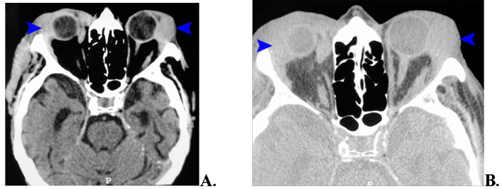 Bilateral Lacrimal Gland Lymphoma - Case Presentation.