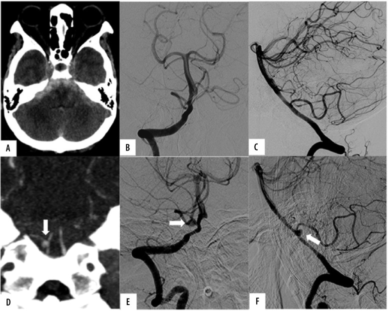 The diagnostic yield of repeat computed tomography angiography in cases of spontaneous subarachnoid haemorrhage after negative initial digital subtraction angiography.