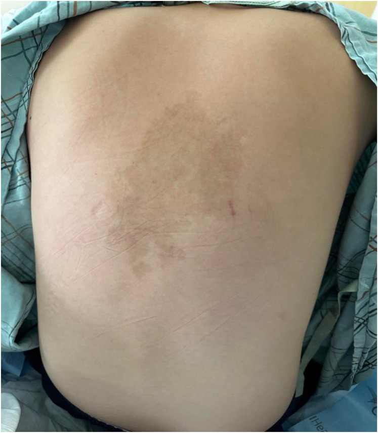 Recurrent Spinal Arteriovenous Malformations in a Patient with Cobb Syndrome.