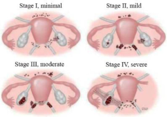 Simultaneous Endometrial Cancer with Extensive Pelvic and Vulvar Endometriosis: A Case Report.