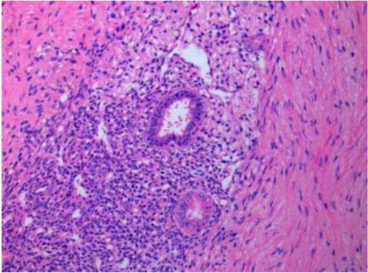 Simultaneous Endometrial Cancer with Extensive Pelvic and Vulvar Endometriosis: A Case Report.