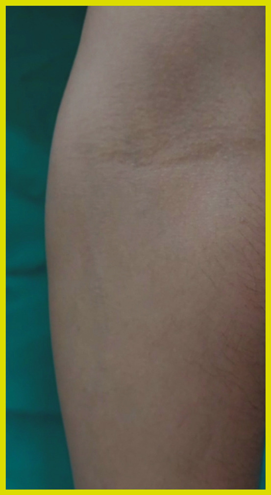 Difficult venesections: An easy solution.