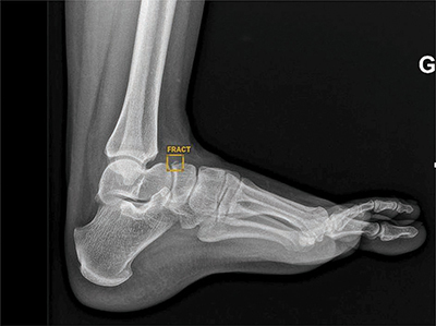 Radiographic Detection of Post-Traumatic Bone Fractures: Contribution of Artificial Intelligence Software to the Analysis of Senior and Junior Radiologists.