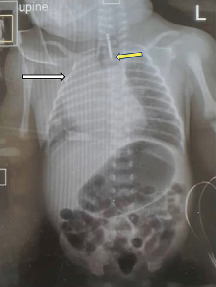 Thoracoscopic Repair of Type C Oesophageal Atresia in a Nigerian Hospital: A Report of Two Cases.