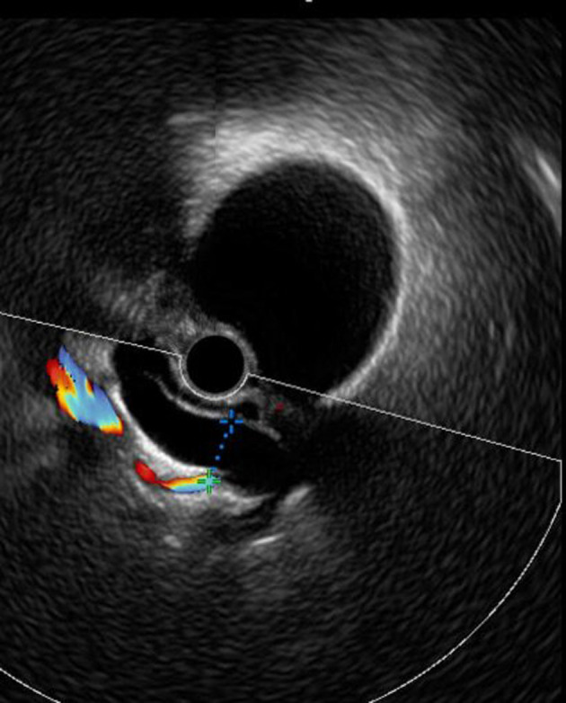 Biliary Tract Disorders and Associated Acute Complications in Patients With Acromegaly: A Single-Center Study.