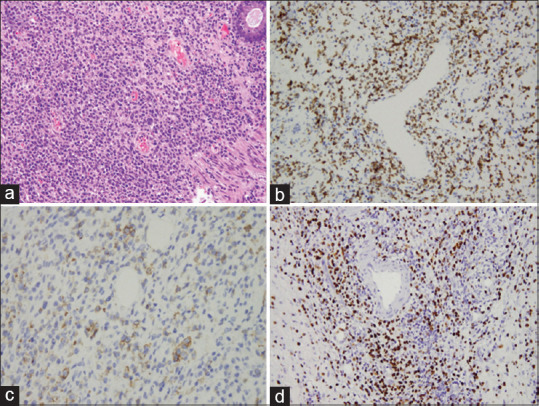 Primary colonic natural-killer T-cell lymphoma mimicking Crohn's disease.