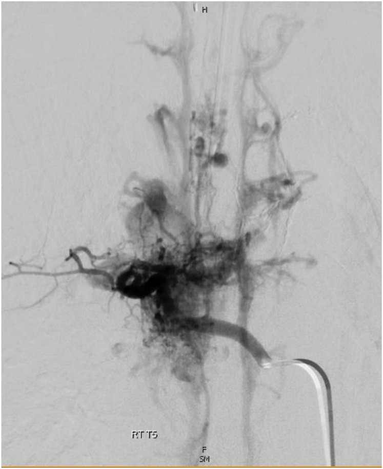 Recurrent Spinal Arteriovenous Malformations in a Patient with Cobb Syndrome.