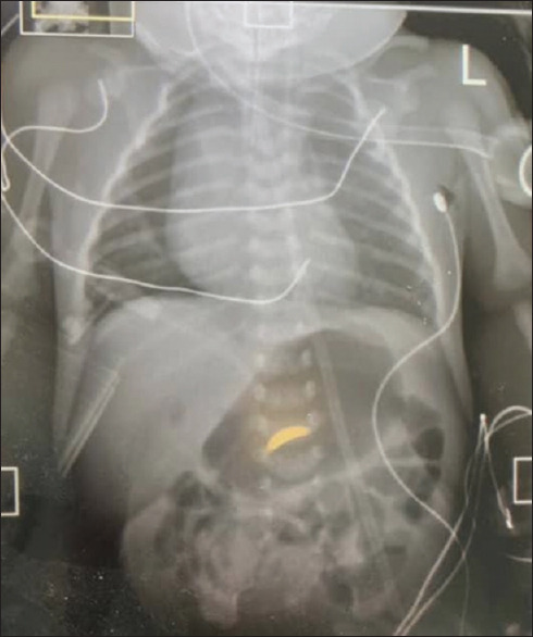 Thoracoscopic Repair of Type C Oesophageal Atresia in a Nigerian Hospital: A Report of Two Cases.