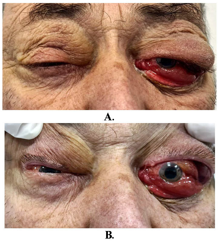 Bilateral Lacrimal Gland Lymphoma - Case Presentation.