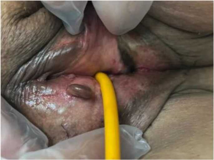 Simultaneous Endometrial Cancer with Extensive Pelvic and Vulvar Endometriosis: A Case Report.