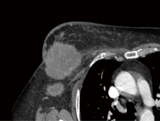 Internal mammary lymphadenopathy in breast cancer: a narrative review and update.