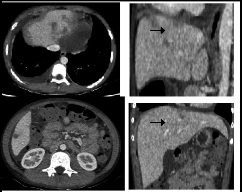 Severe Acute Respiratory Distress in a Child with Hypereosinophilic Syndrome: A Case Report.