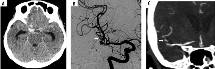 The diagnostic yield of repeat computed tomography angiography in cases of spontaneous subarachnoid haemorrhage after negative initial digital subtraction angiography.