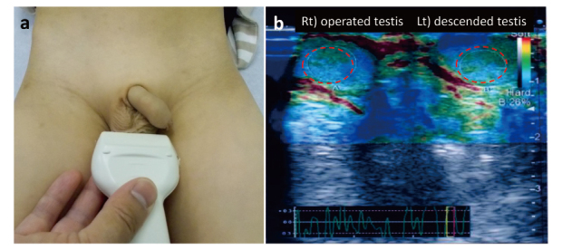 Evaluation of testicular stiffness in boys with unilateral cryptorchidism after orchiopexy by ultrasound strain elastography.