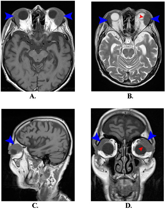 Bilateral Lacrimal Gland Lymphoma - Case Presentation.