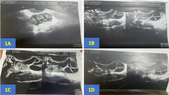 A Bizarre Case of Periovarian Hematoma in a Patient Undergoing Controlled Ovarian Stimulation Managed Conservatively.