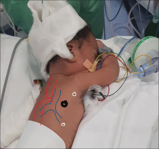 Thoracoscopic Repair of Type C Oesophageal Atresia in a Nigerian Hospital: A Report of Two Cases.