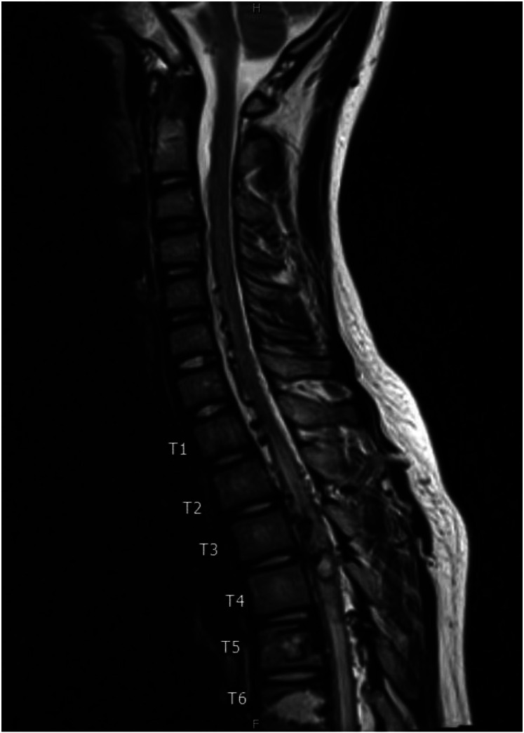 Recurrent Spinal Arteriovenous Malformations in a Patient with Cobb Syndrome.