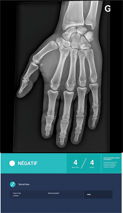 Radiographic Detection of Post-Traumatic Bone Fractures: Contribution of Artificial Intelligence Software to the Analysis of Senior and Junior Radiologists.