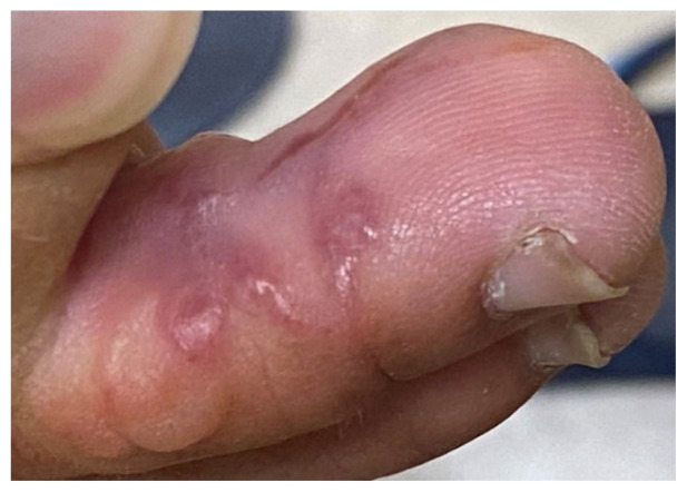 Case Report of Serpiginous Rash on Foot in a Patient after Recent Travel to Brazil.