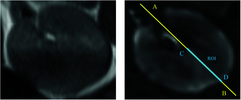 Pathological Factors Affecting the R2* Values of the Kidney in Blood Oxygenation Level-dependent MR Imaging: A Retrospective Study.