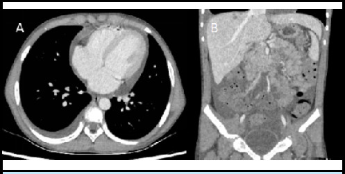 Severe Acute Respiratory Distress in a Child with Hypereosinophilic Syndrome: A Case Report.