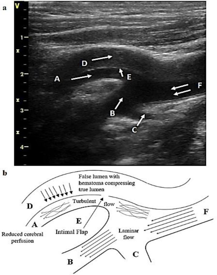 Transient global amnesia in a patient with painless spontaneous internal carotid artery dissection: An unusual but possible underlying cause.