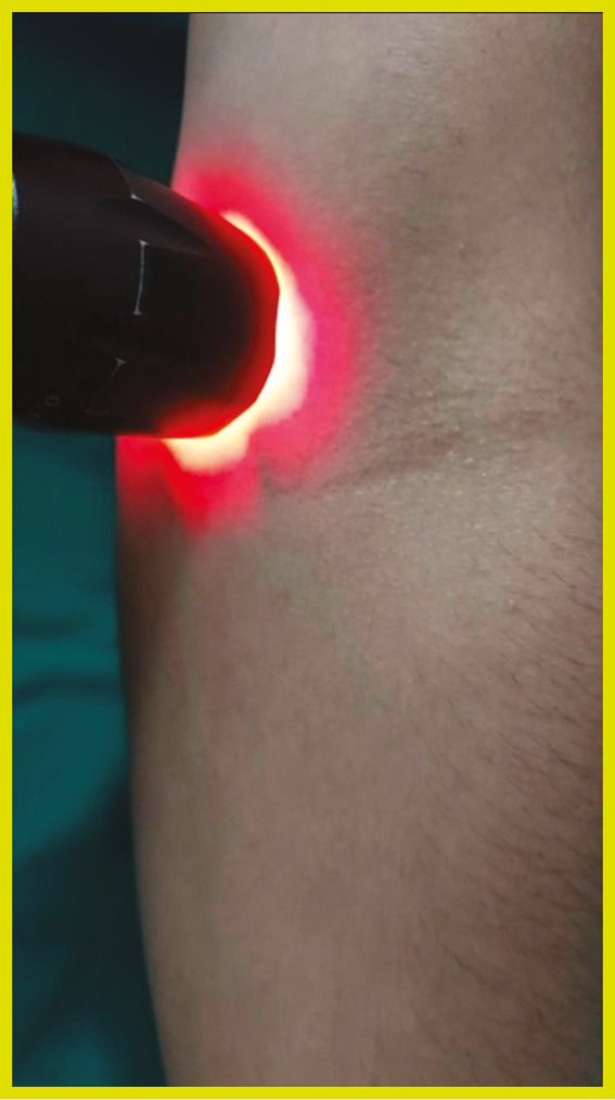 Difficult venesections: An easy solution.