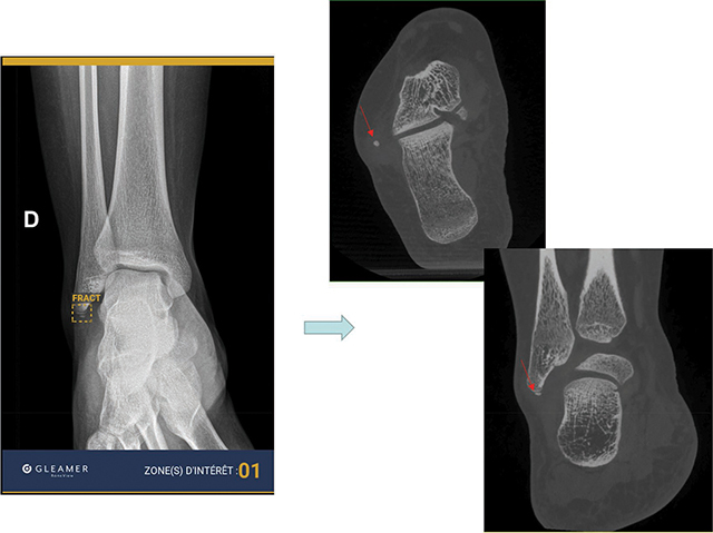 Radiographic Detection of Post-Traumatic Bone Fractures: Contribution of Artificial Intelligence Software to the Analysis of Senior and Junior Radiologists.