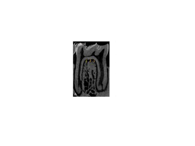 Periodontal status and mandibular biomechanics in rats subjected to hyposalivation and periodontitis.