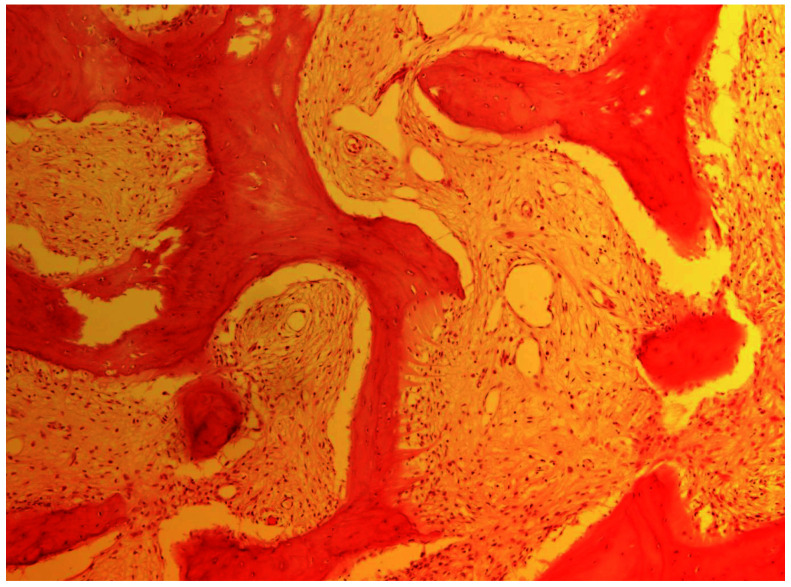 OSTEOSARCOMA IN A PATIENT WITH CRANIAL FIBROUS DYSPLASIA: A CASE REPORT.