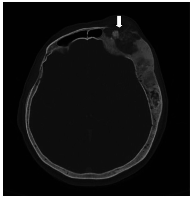 OSTEOSARCOMA IN A PATIENT WITH CRANIAL FIBROUS DYSPLASIA: A CASE REPORT.