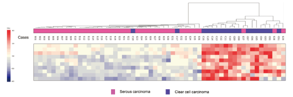 Differentiation of ovarian serous carcinoma from ovarian clear cell carcinoma using a 10-gene signature selected by comprehensive gene expression analysis.