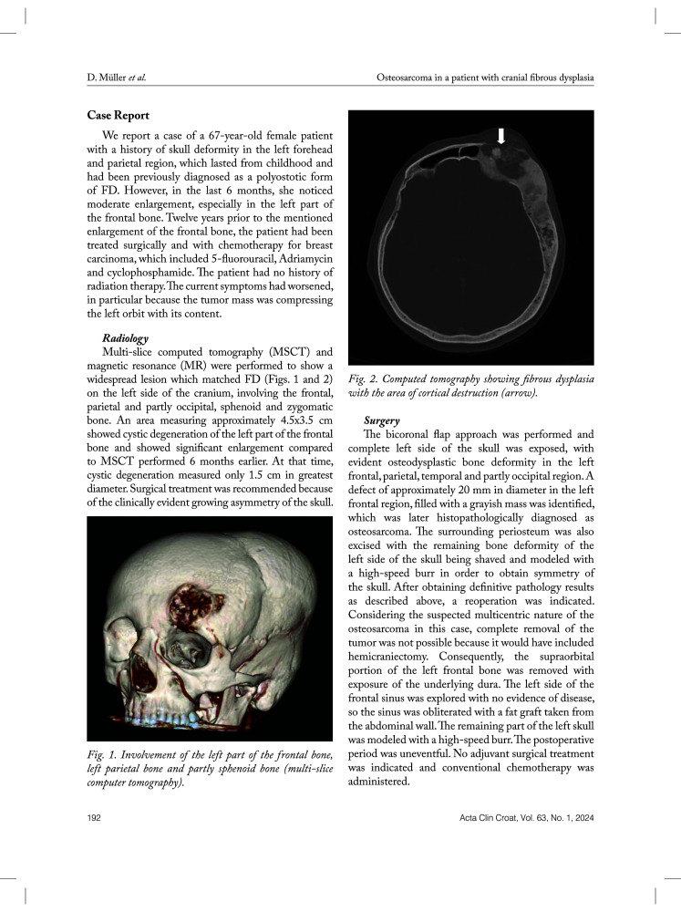 OSTEOSARCOMA IN A PATIENT WITH CRANIAL FIBROUS DYSPLASIA: A CASE REPORT.