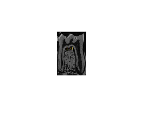 Periodontal status and mandibular biomechanics in rats subjected to hyposalivation and periodontitis.